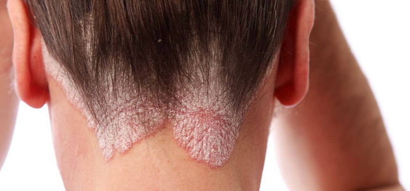 A korpás fejbőr kezelése - Bőrproblémák: pikkelysömör, ekcéma, korpa kezelése
